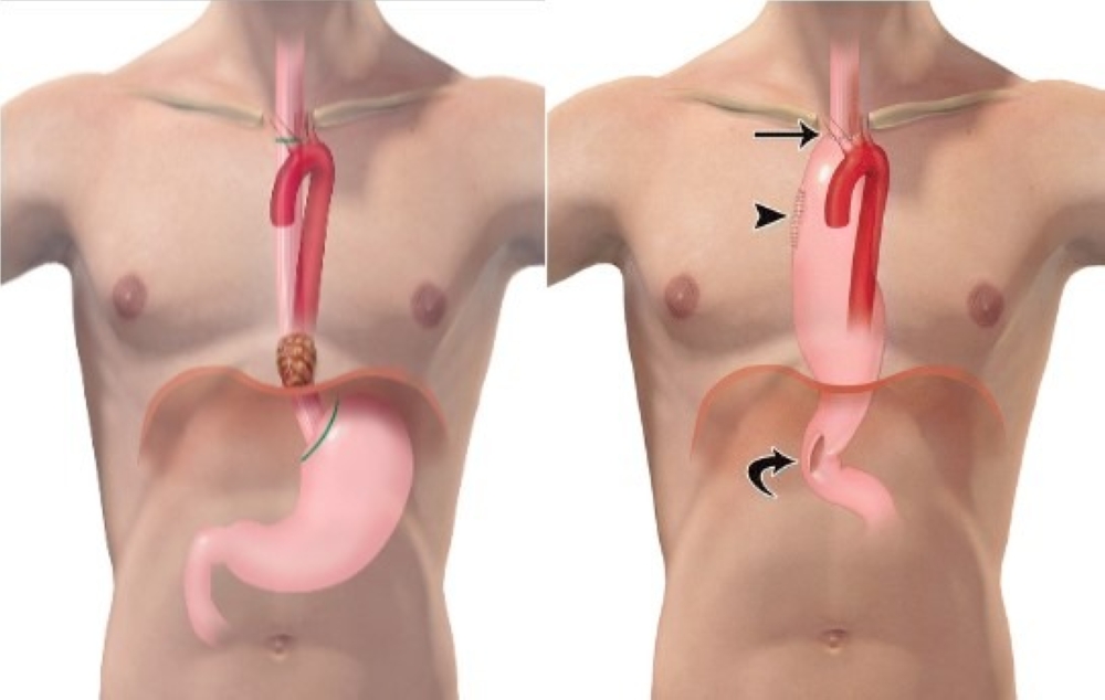نجاح-أول-عملية-استئصالٍ-للمريء-لمريض-مصاب-بالسرطان-في-مستشفيات-المانع-بالخُبَر