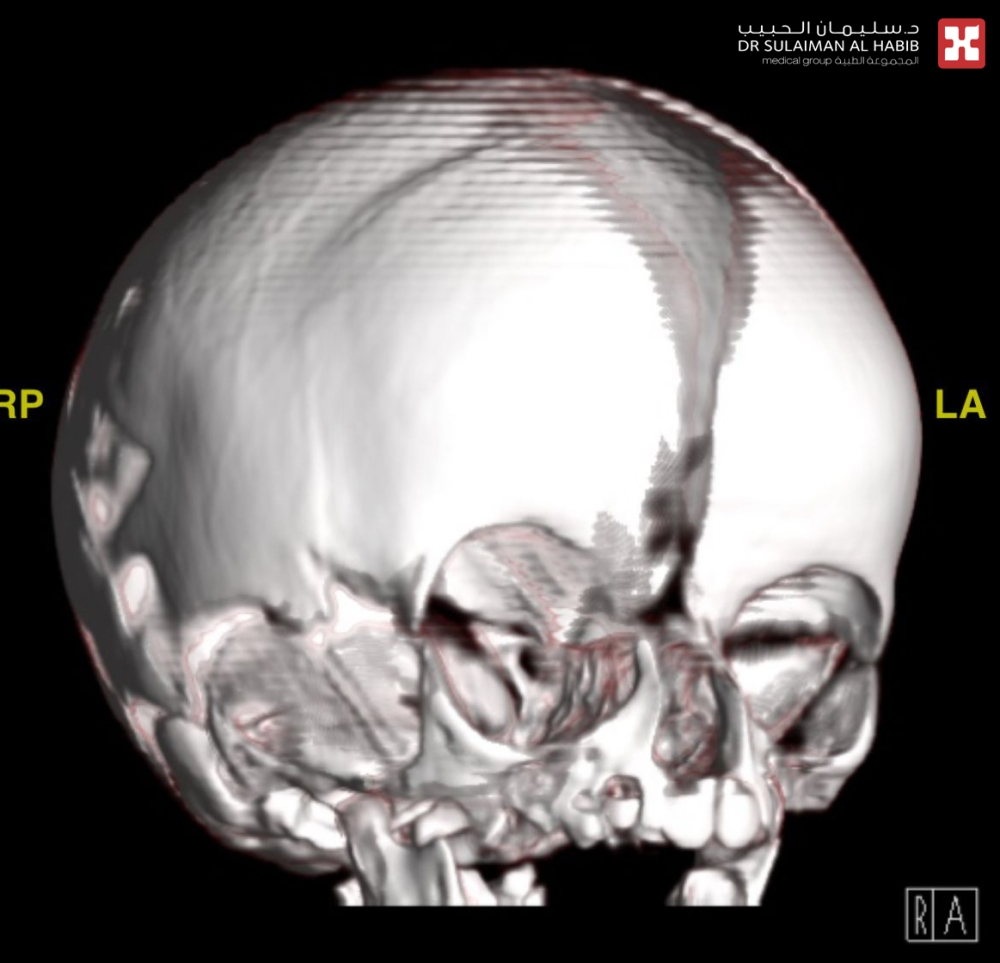 مستشفى-الدكتور-سليمان-الحبيب-بالخبر-يُعيد-بناء-عظام-الجمجمة-بالمنظار-لرضيعه-تعاني-من-تشوه-خلقي