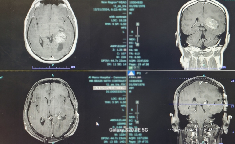 إزالة-ورم-دماغيّ-لمريضٍ-أثناء-اليقظة-في-مستشفيات-المانع-بالدمام