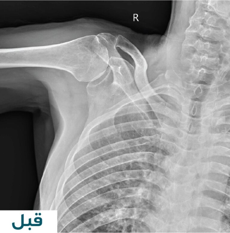 استبدال-مِفصل-الكتف-يُعيد-الحركة-لمريض-سبعينيّ-في-مستشفى-المانع-بالأحساء