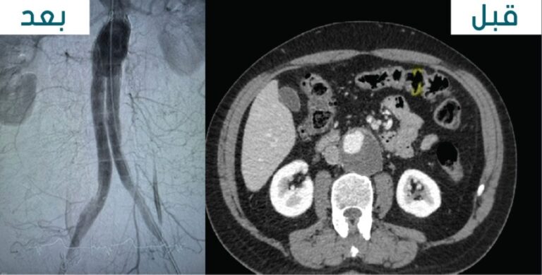 نجاح-عملية-إصلاح-تمدد-الشريان-الأورطي-البطني-لمريض-يبلغ-من-العمر-69-عامًا