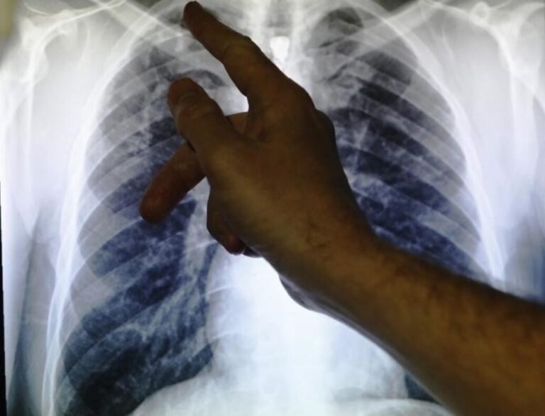 الصحة-العالمية:-السل-تسبب-في-وفاة-1,23-مليون-شخص-خلال-2024