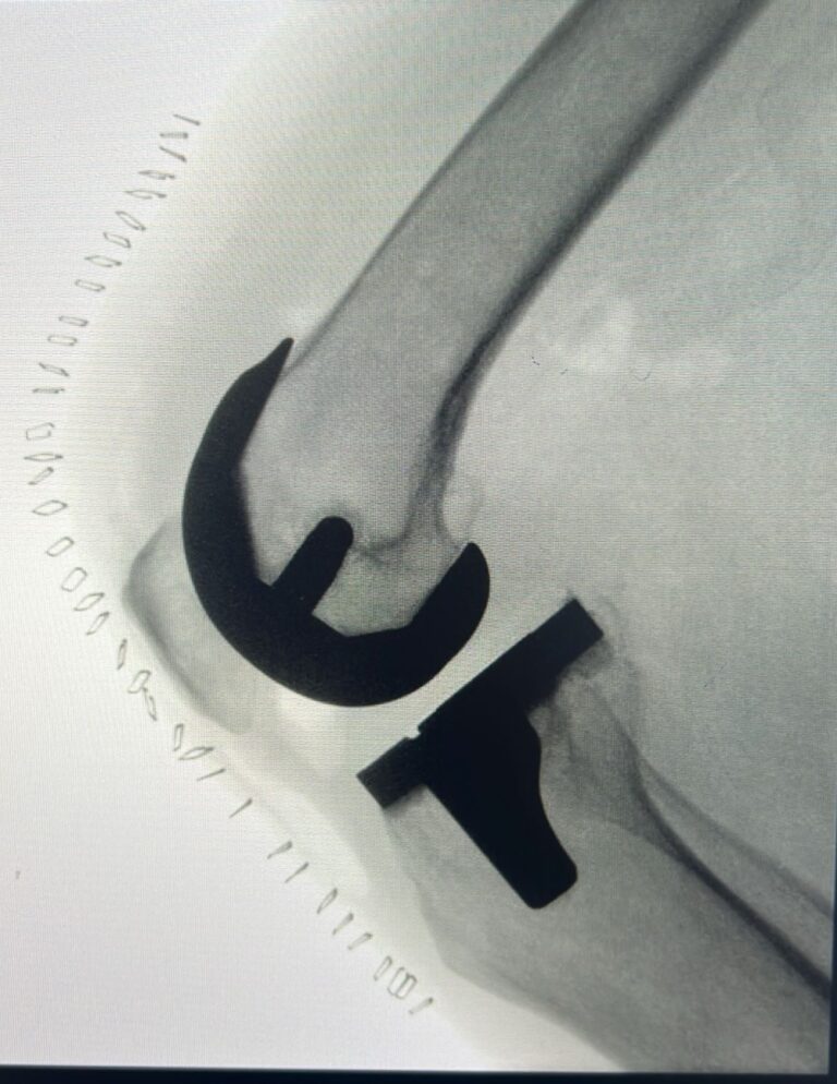 بتقنيات-حديثة.-استبدال-مفصل-الركبة-والمشي-دون-ألم-في-نفس-اليوم