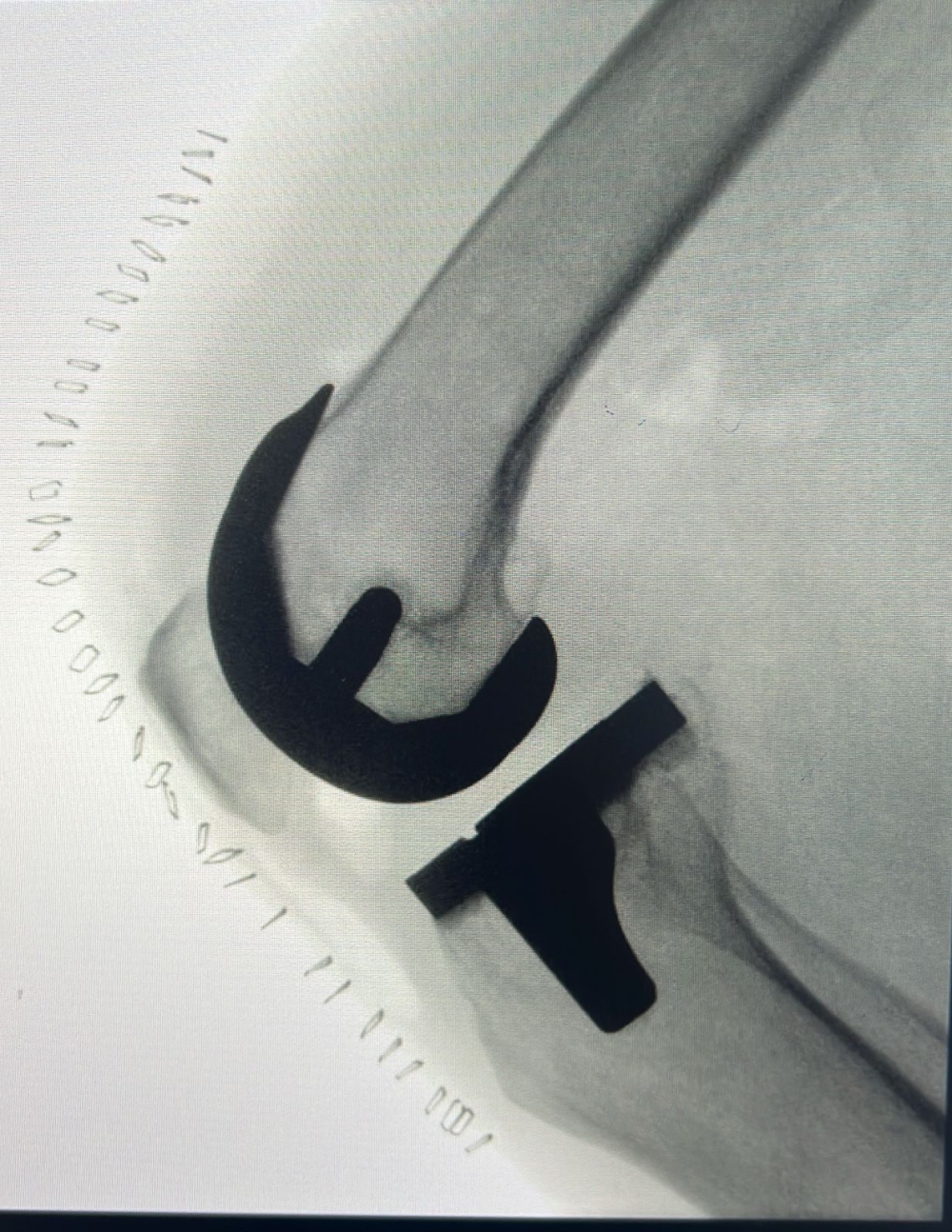 بتقنيات-حديثة.-استبدال-مفصل-الركبة-والمشي-دون-ألم-في-نفس-اليوم