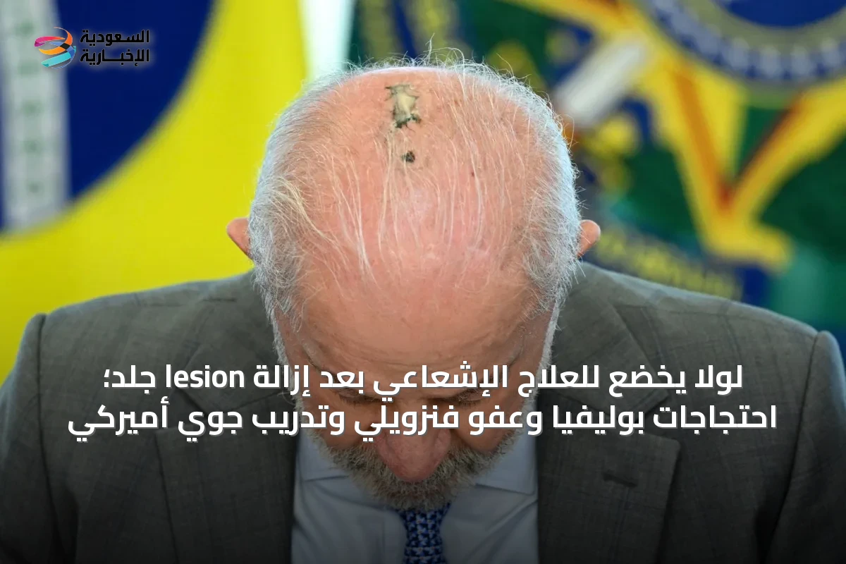 لولا يخضع للعلاج الإشعاعي بعد إزالة lesion جلد؛ احتجاجات بوليفيا وعفو فنزويلي وتدريب جوي أميركي