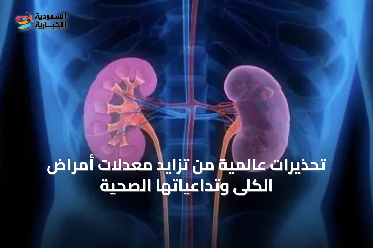 تحذيرات عالمية من تزايد معدلات أمراض الكلى وتداعياتها الصحية