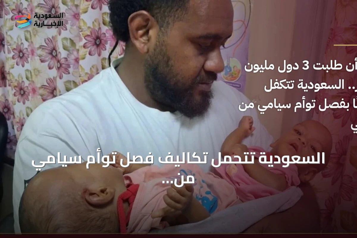 السعودية تتحمل تكاليف فصل توأم سيامي من فيجي بعد رفض دول أخرى دفع مبلغ مسبق