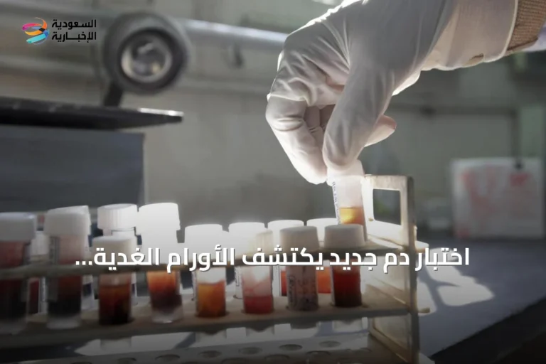 اختبار دم جديد يكتشف الأورام الغدية المتقدمة قبل أن تتحول إلى سرطان القولون والمستقيم