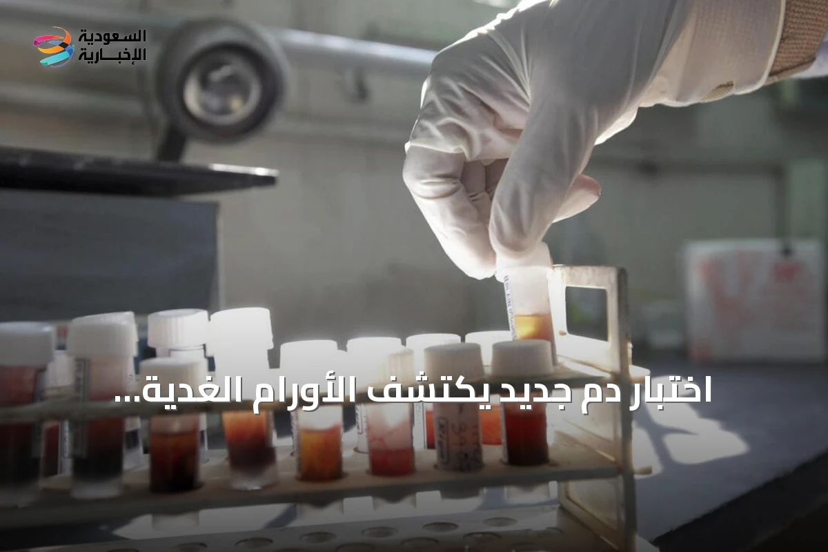 اختبار دم جديد يكتشف الأورام الغدية المتقدمة قبل أن تتحول إلى سرطان القولون والمستقيم
