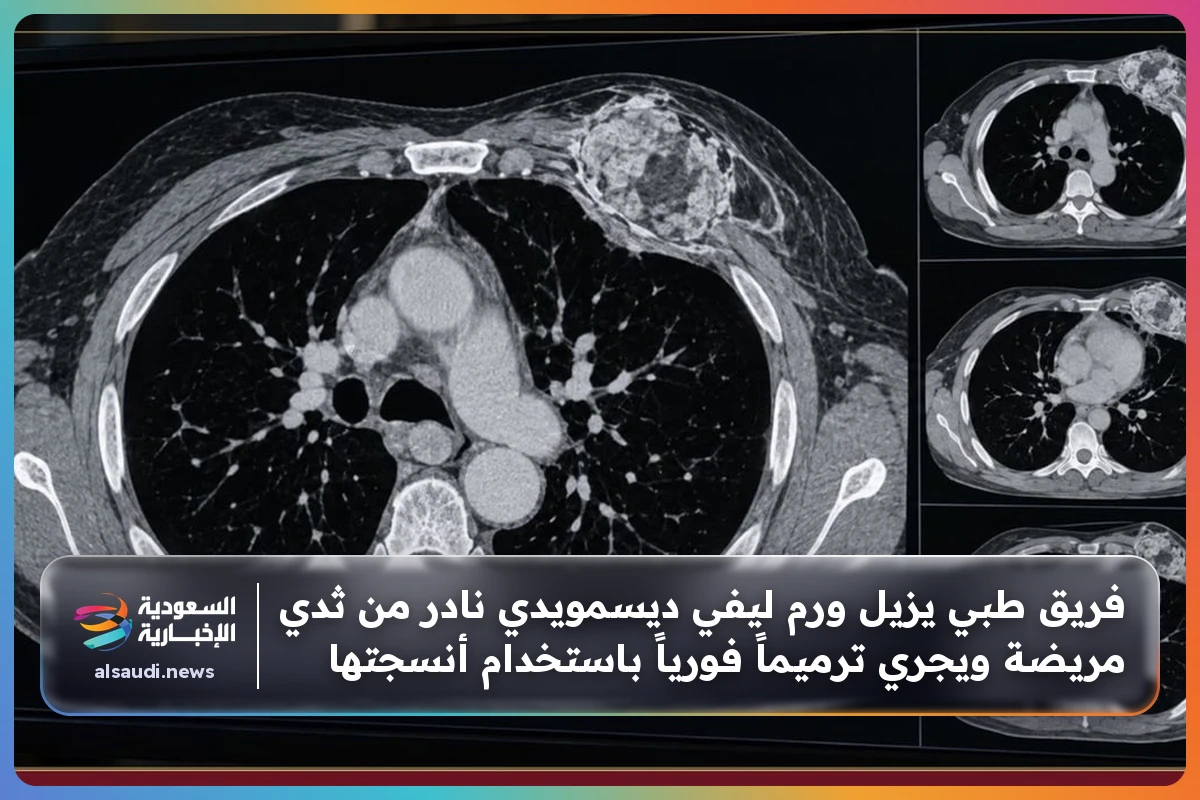 فريق طبي يزيل ورم ليفي ديسمويدي نادر من ثدي مريضة ويجري ترميماً فورياً باستخدام أنسجتها