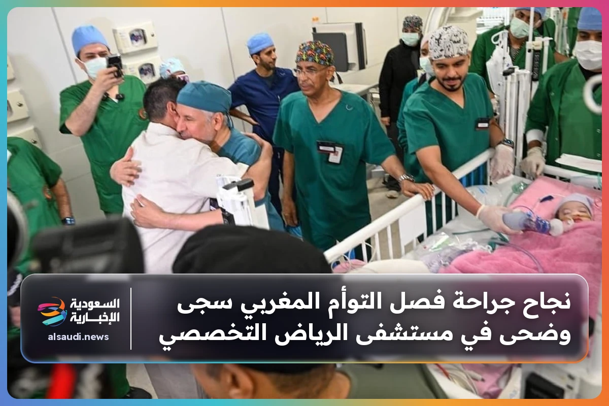 نجاح جراحة فصل التوأم المغربي سجى وضحى في مستشفى الرياض التخصصي