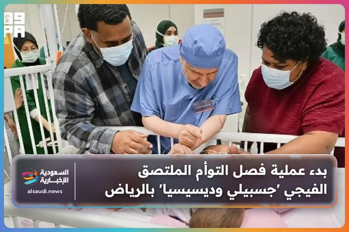 بدء عملية فصل التوأم الملتصق الفيجي 'جسبيلي وديسيسيا' بالرياض